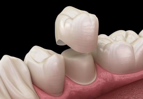 Animated smile during dental crown restorative dentistry treatment