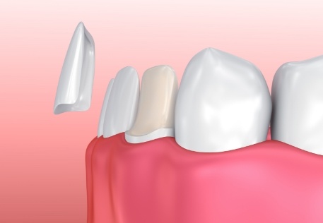 Animated smile during single tooth cosmetic dental bonding
