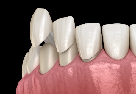 Animated smile during multiple tooth dental bonding