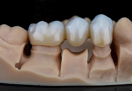 Woman smiling with a dental bridge in Dallas