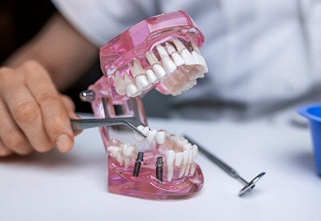 A dentist showing what an implant bridge looks like