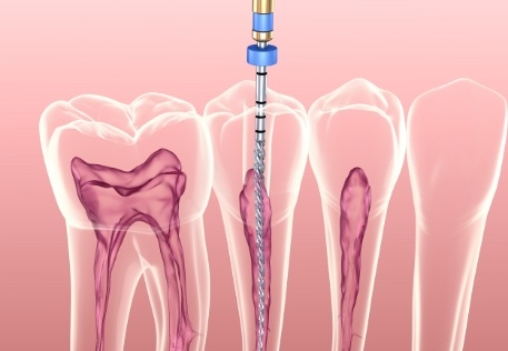 Animated smile during root canal therapy