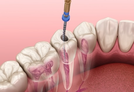 Animated smile showing root canal process