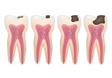 Animated tooth showing advanced decay before root canal therapy