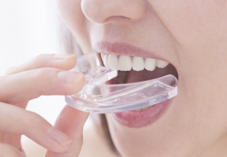 Dental patient placing nightguard for bruxism