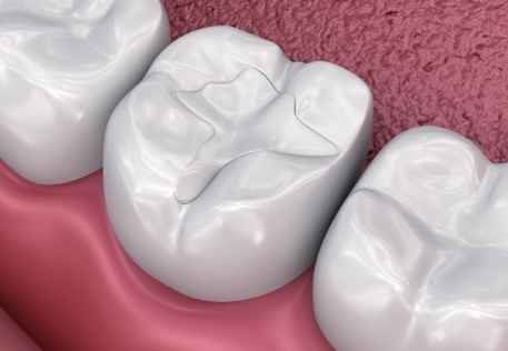 Animated smile with dental sealants