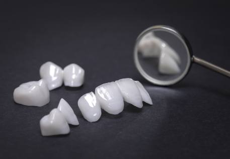 Porcelain veneers prior to placement during cosmetic dentistry treatment
