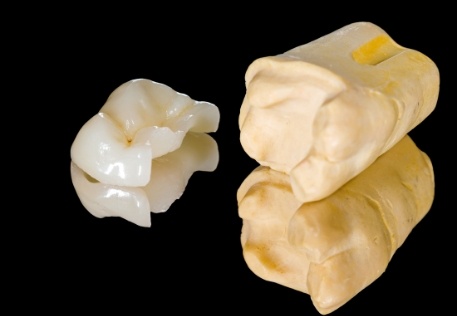 Model tooth with metal free dental restoration