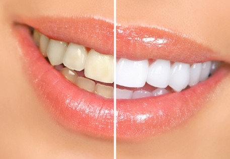 Smile before and after teeth whitening