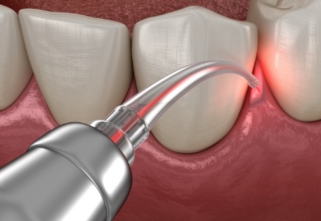 Animated smile during gum recontouring treatment