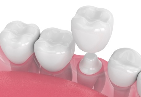 Animated smile during dental crown placement