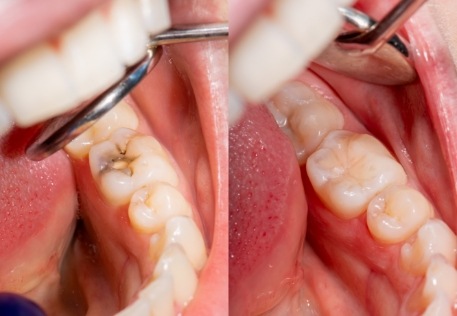 Smile before and after tooth colored filling restoration
