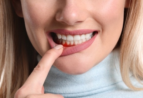 Woman with inflamed gums before periodontal disease treatment