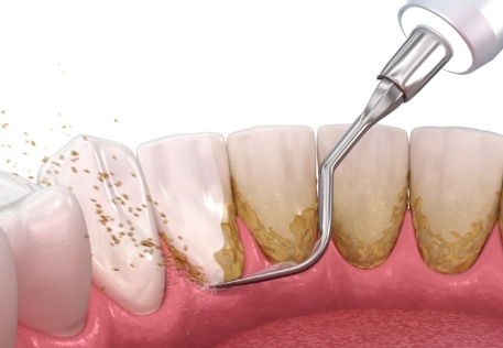 Animated smile during periodontal disease treatment