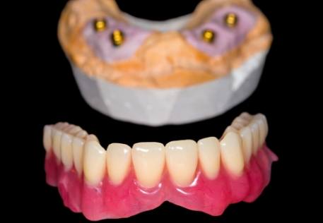 Model dental implant supported denture