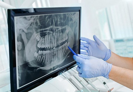 gloved hands pointing at a dental X-ray on a screen