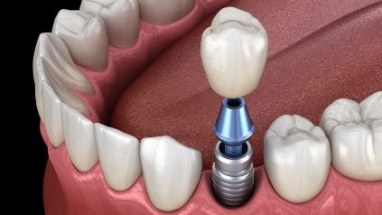 Animated smile during dental implant supported dental crown placement