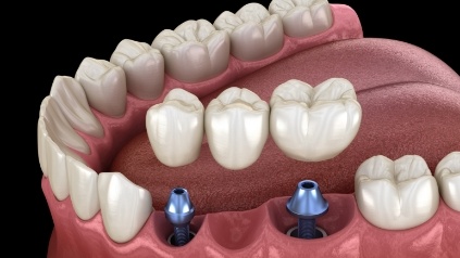 Animated smile during dental implant supported fixed bridge placement