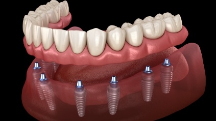 Animated smile during dental implant supported denture placement