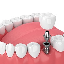 Diagram showing components of a dental implant in Dallas