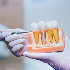 Implant dentist in Dallas pointing at a dental implant model
