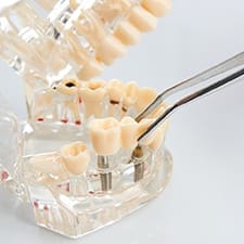 dentist placing restoration for model dental implants in Dallas 