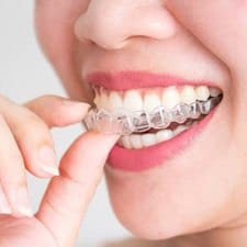 smile and clear aligner