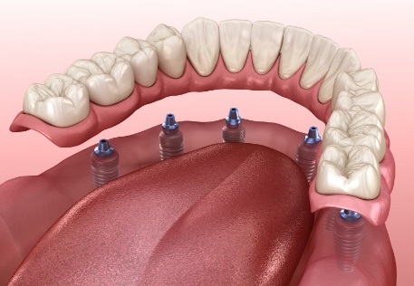 Animated smile during dental implant supported denture placement