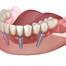 A diagram of dental-implant retained dentures in Dallas.