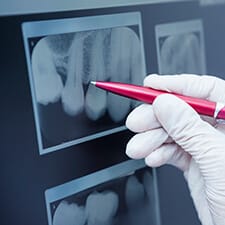 dentist using pen to point to x-ray