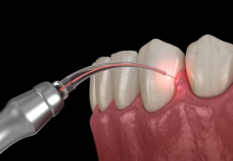 Animated smile during soft tissue laser dentistry treatment