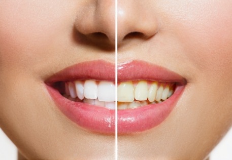 Smile before and after teeth whitening