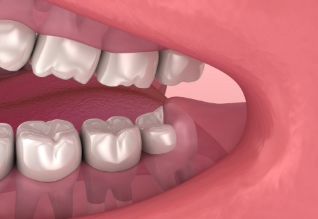 Animated smile with impacted wisdom tooth