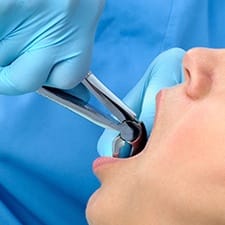 Closeup of patient during tooth extraction