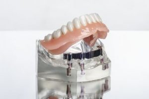 An implant-retained denture