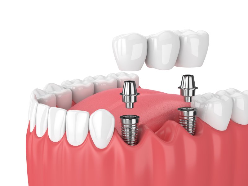 a digital image of an implant bridge on the lower arch