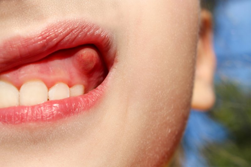 A patient with a bump on their gums