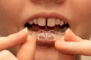 Clear aligner used to fix gapped teeth